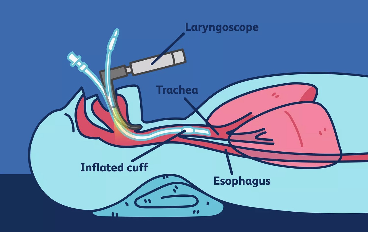 What is endotracheal intubation and why is it done