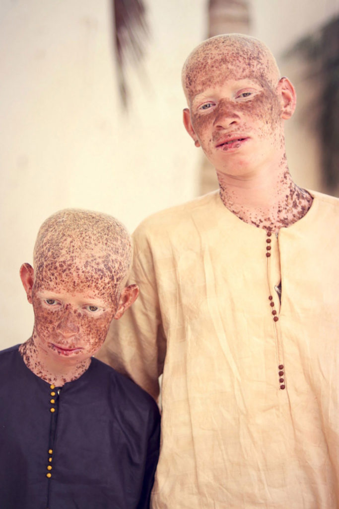 What to know about the Albino people and Albino disease? - 824News